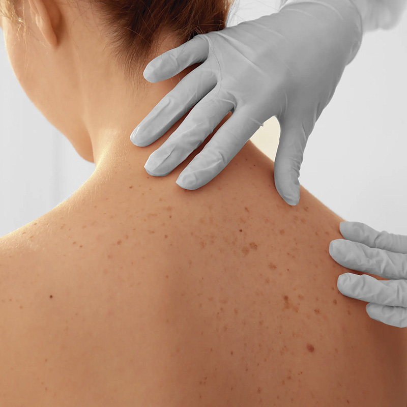 tratamiento queratosis o cáncer de piel dermatóloga Valladolid